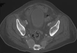 Metastatic Renal Cancer - CTisus CT Scan