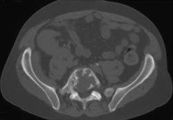 Myeloma - CTisus CT Scan