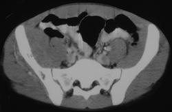 Lymphoma - CTisus CT Scan