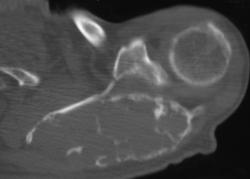 Metastatic Renal Cell Carcinoma - CTisus CT Scan