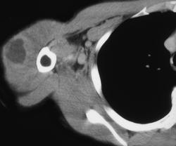 Abscess - CTisus CT Scan