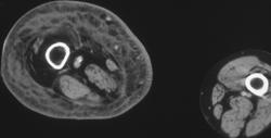 Cellulitis - CTisus CT Scan