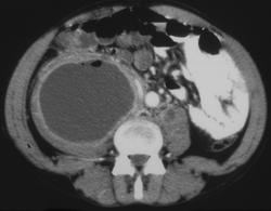 Psoas Abscess - CTisus CT Scan