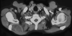 Metastases to Muscle Due to Renal Cell Carcinoma - CTisus CT Scan