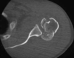 Humerus Fracture/ Dislocation - CTisus CT Scan