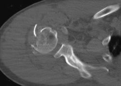 Humerus Fracture - CTisus CT Scan