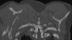 Scapular Fracture - CTisus CT Scan