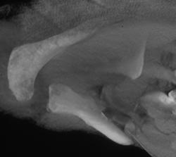 Fracture / Dislocation of Sternoclavicular Joint (SC Joint) - CTisus CT Scan