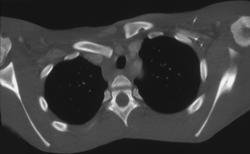 Posterior Dislocation of Clavicular Head - CTisus CT Scan