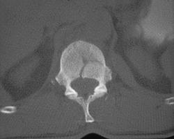 Spinal Fracture - CTisus CT Scan