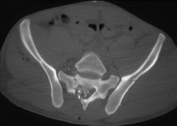 Gun Shot Wound to the Sacrum - CTisus CT Scan