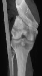 Femur Fracture - CTisus CT Scan