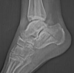 Calcaneal Fracture - CTisus CT Scan