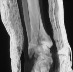 Tibial Fracture - CTisus CT Scan