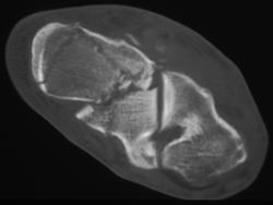 Calcaneal Fracture - CTisus CT Scan