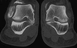 Tarsal Coalition on the Left - CTisus CT Scan