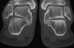 Fibrous Tarsal Coalition - CTisus CT Scan