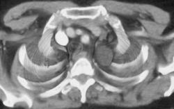 Neurofibroma - CTisus CT Scan