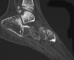 Osteoporosis - CTisus CT Scan