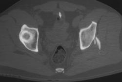 Posterior Acetabular Fracture - CTisus CT Scan