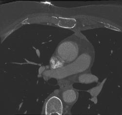 Sternal Fracture - CTisus CT Scan