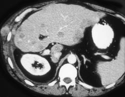 Recurrent Tumor in Abdominal Wall (hx Colon Cancer) - CTisus CT Scan
