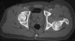 Hip Disloaction With Fracture - CTisus CT Scan