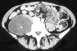 Liposarcoma - CTisus CT Scan