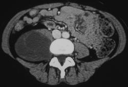 Liposarcoma - CTisus CT Scan