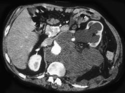 Recurrent Chordoma - CTisus CT Scan