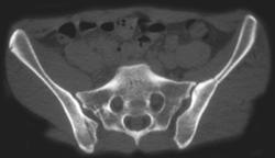 Iliac Fracture - CTisus CT Scan