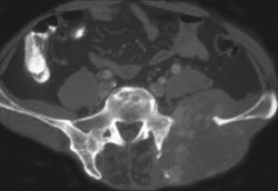 Metastatic Thyroid Cancer - CTisus CT Scan