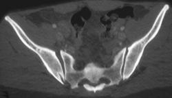 Fracture With Widening of Right SI Joint - CTisus CT Scan