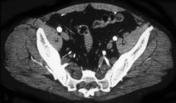 Neurofibromatosis - CTisus CT Scan