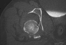 Fracture / Dislocation of the Hip - CTisus CT Scan