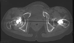 Pinning of Slipped Capital Femoral Epiphysis (SCFE) - CTisus CT Scan