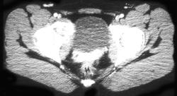 Aneurysmal Bone Cyst- Right Acetabulum - CTisus CT Scan