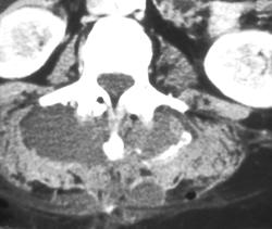 Paraspinal Abscess - CTisus CT Scan