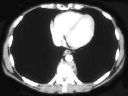 Tuberculosis (TB) of the Spine - CTisus CT Scan