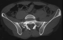 Sacral Fracture - CTisus CT Scan