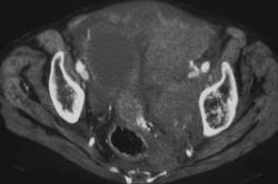 Pelvic Hematoma S/P Angiography - CTisus CT Scan