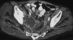 Abscess in Gluteal Muscle - CTisus CT Scan