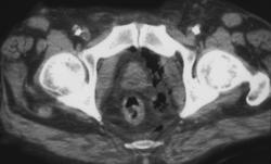 Necrotizing Fasciitis - CTisus CT Scan