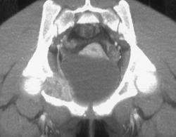 Aneurysmal Bone Cyst - CTisus CT Scan