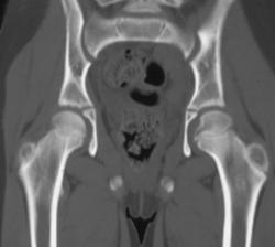 Left Sacroiliitis Due to Lyme Disease - CTisus CT Scan