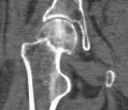 Impacted Right Femur Fracture - CTisus CT Scan