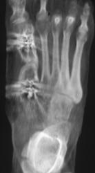 Pin in First Metatarsal Following Lengthening Procedure - CTisus CT Scan