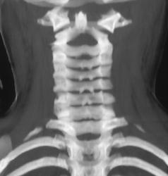 C-spine Fracture - CTisus CT Scan