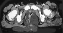 Lymphangioma - CTisus CT Scan