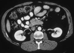 Retroperitoneal Liposarcoma - CTisus CT Scan